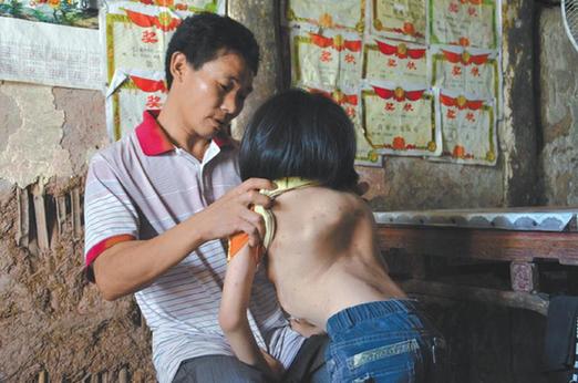 有嚴(yán)重脊椎畸形及胸腔隆突病的李文霞。