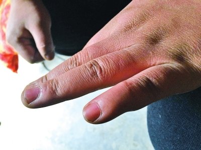 哥為給弟看病無(wú)錢支付彩禮 夫妻吵架自殘剁手指