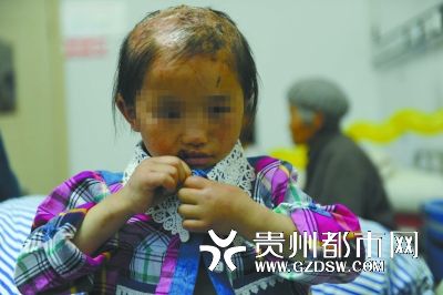 被燙傷的頭皮一直沒(méi)有愈合。