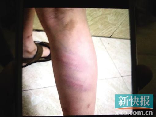 小宇腿部有明顯瘀痕。 翻拍自家屬手機(jī)