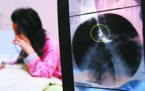 假牙上的鋼絲刺破食管，而薄薄的食道壁緊貼主動脈血管，極易造成血管破裂