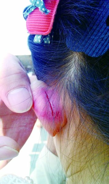 　　女童的耳朵被老師揪裂。圖片由女童家人提供