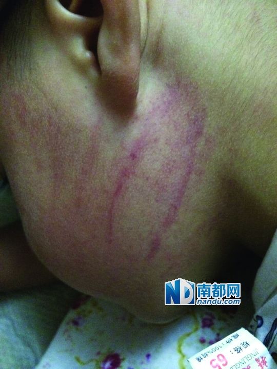 小逸臉上淤痕清晰可見。