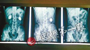 ▲片子上能看見巨大結(jié)石 ▲片子上能看見巨大結(jié)石