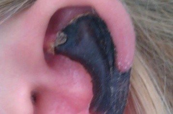 荷蘭女子旅游途中被蜘蛛咬，耳軟骨溶解變黑。