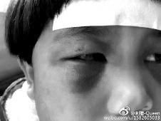 6月2日，網(wǎng)曝渭南市臨渭區(qū)一不滿(mǎn)5歲的女童遭奶奶毆打，眼圈青腫，引起網(wǎng)友關(guān)注，但孩子父母和爺爺均稱(chēng)是摔倒導(dǎo)致。相關(guān)部門(mén)介入調(diào)查發(fā)現(xiàn)確為奶奶毆打所致，鑒于其身體原因已進(jìn)行批評(píng)教育。