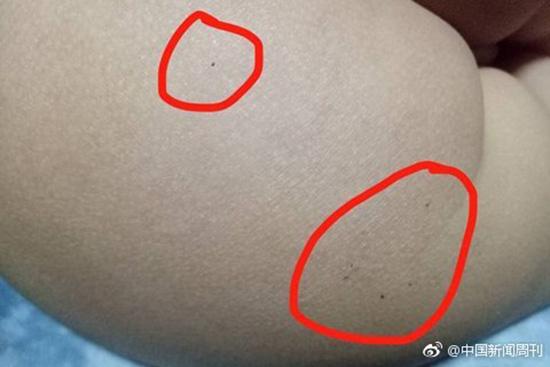 據(jù)多名紅黃藍(lán)(新天地分園)家長反映，孩子腿部、屁股、腋下出現(xiàn)針眼。