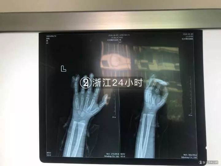 嚇哭！6歲男孩被夾斷手指 罪魁禍?zhǔn)拙故切７? oldsrc=