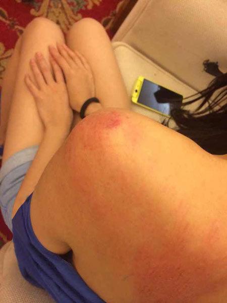 “跑男”真的很拼！baby朋友圈曬后背紅腫照