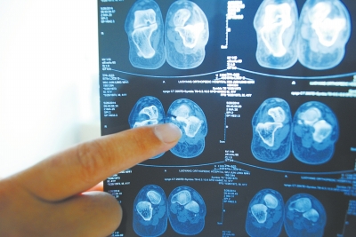 X光片顯示,確實(shí)有一根殘留的螺絲釘。