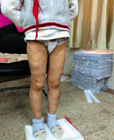 4月3日晚，微博網(wǎng)友“@朝廷半日閑”發(fā)圖文微博展示男童被虐待的慘狀。 微博截圖