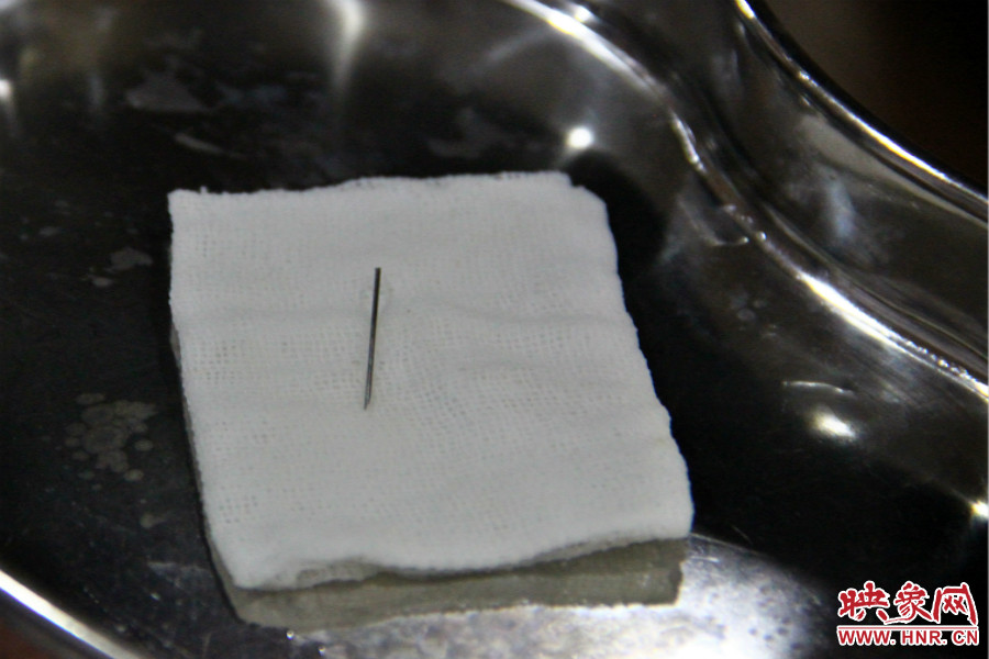 上午11點30分許，小龍腦中鋼針已經(jīng)成功取出。