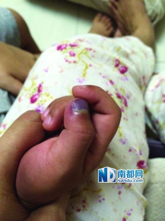 小逸手指被夾傷。