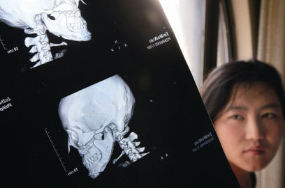 國(guó)內(nèi)醫(yī)院CT顯示，如今靳魏坤的鼻子假體是歪的，連下巴也是歪的