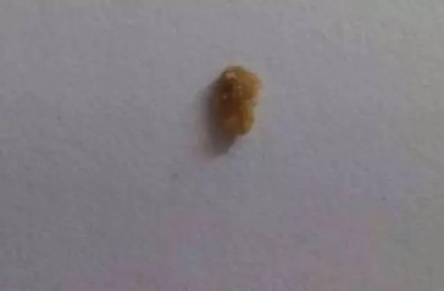 55歲大爺因愛吃豆腐 體內(nèi)取出420顆結(jié)石 55歲大爺因愛吃豆腐 體內(nèi)取出420顆結(jié)石