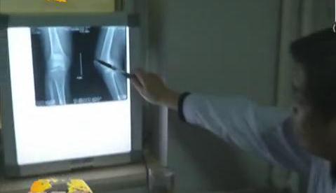 冷空氣來(lái)襲 如何預(yù)防老寒腿？